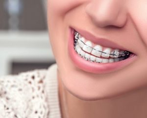 بهداشت دهان و دندان در طول درمان با ارتودنسی