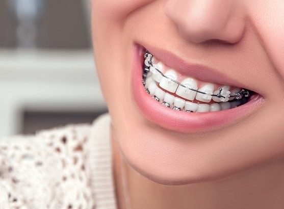 بهداشت دهان و دندان در طول درمان با ارتودنسی