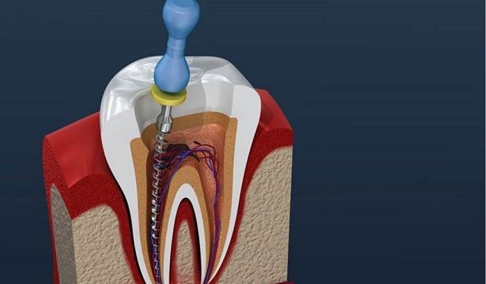 درمان ریشه دندان