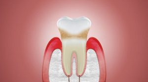 علت بیماری لثه و پریودنتال چیست؟