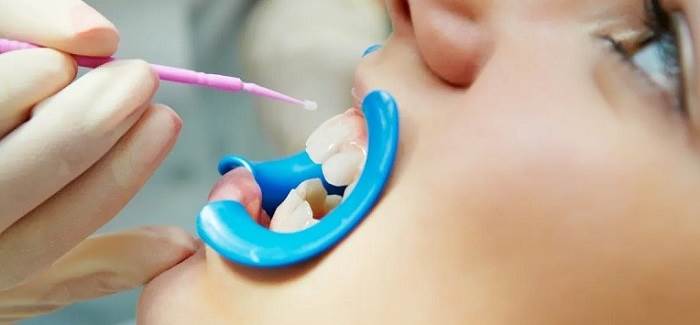 فیشورسیلانت تراپی برای پیشگیری از پوسیدگی دندان ها