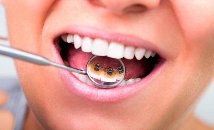 مدت زمان استفاده از بریس دندانی