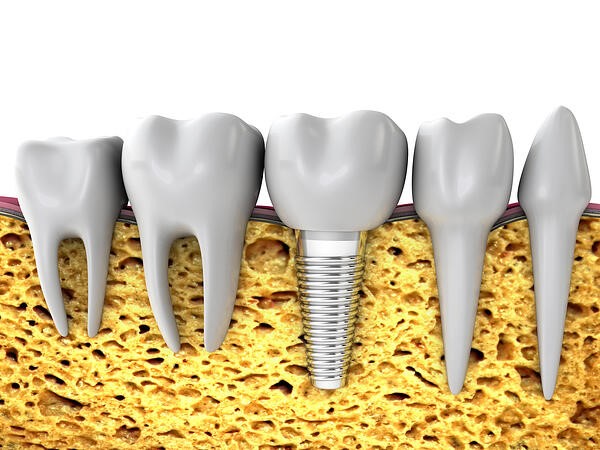 مراحل ایمپلنت دندان: معاینه، کاشت و مراقبت