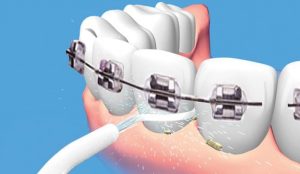 مزایا و کاربرد واترجت دندان