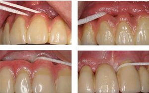 نخ-دندان-Bridge-and-Implant-Floss-برای-تمیز-کردن-زیر-بریج2