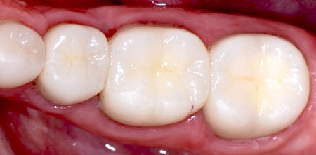 پرکننده‌های کامپوزیت همرنگ دندان